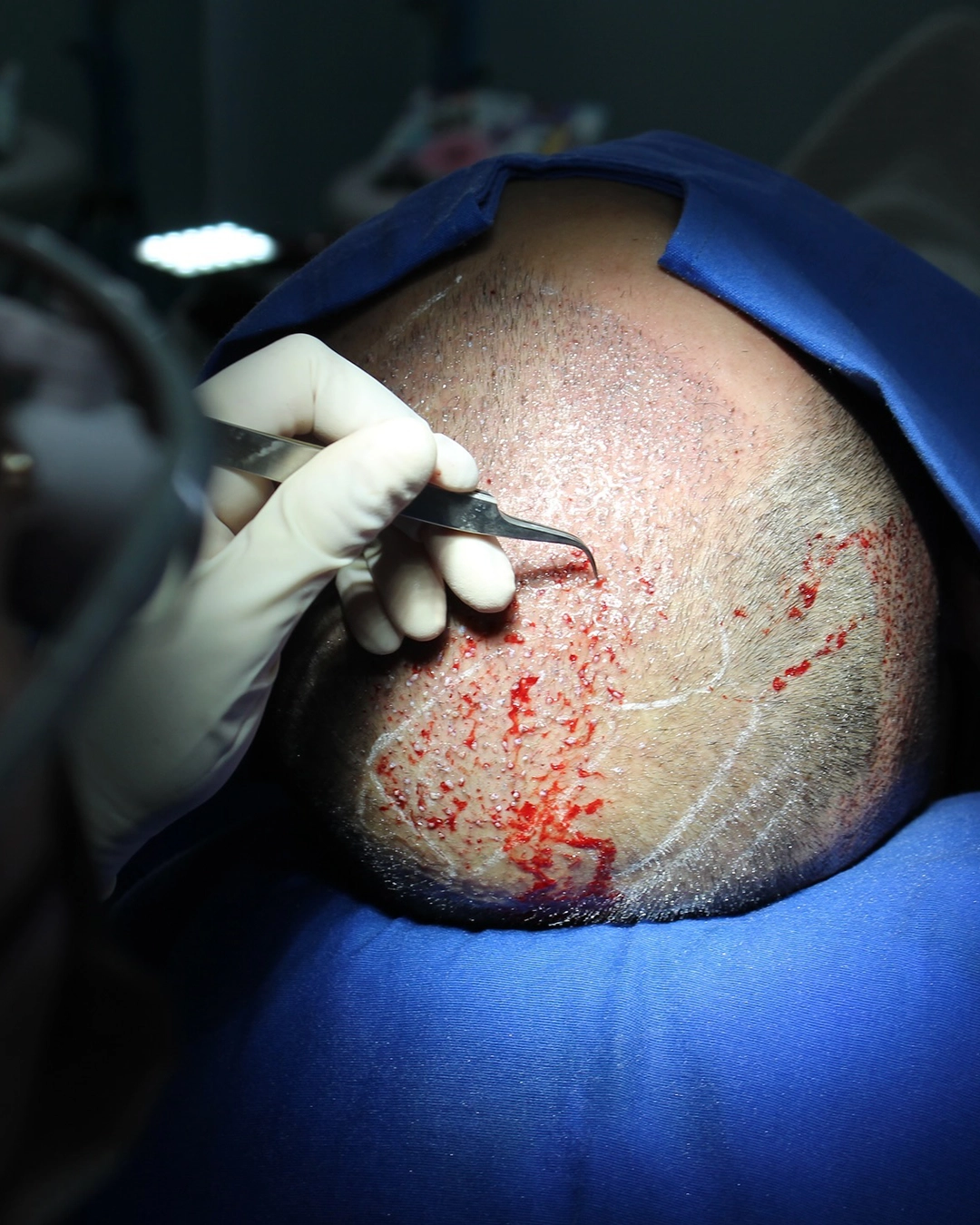 Hair transplant 1080×1350 IM10