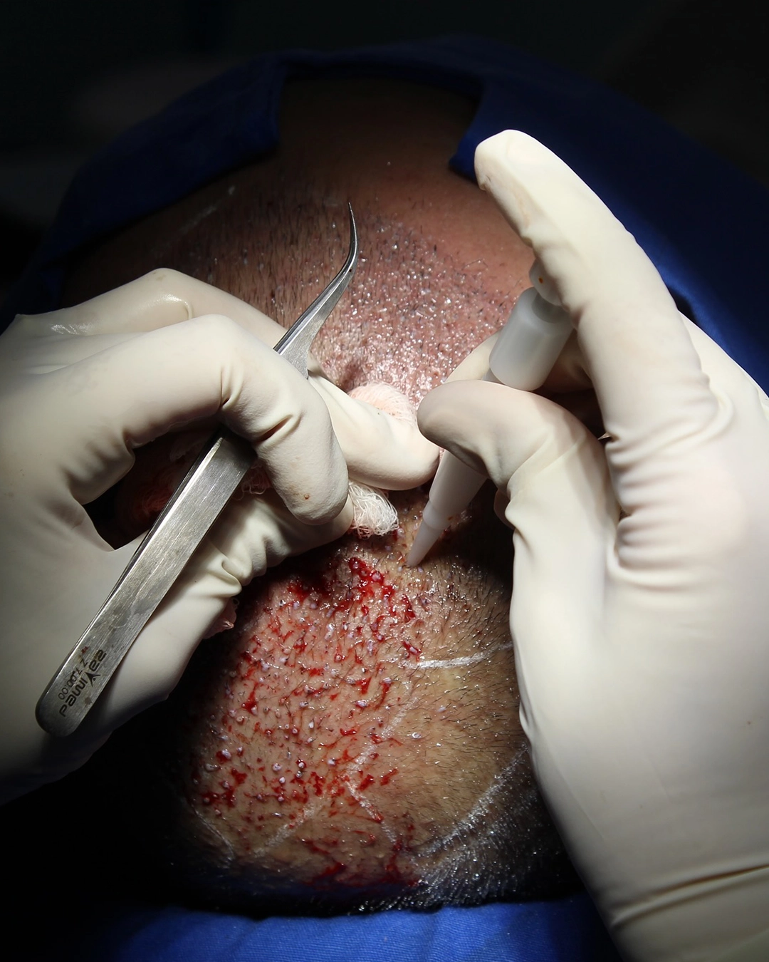 Hair transplant 1080×1350 IM11