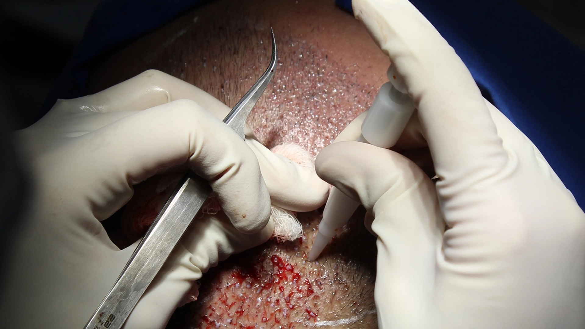 Hair transplant 1080×1920 IM3