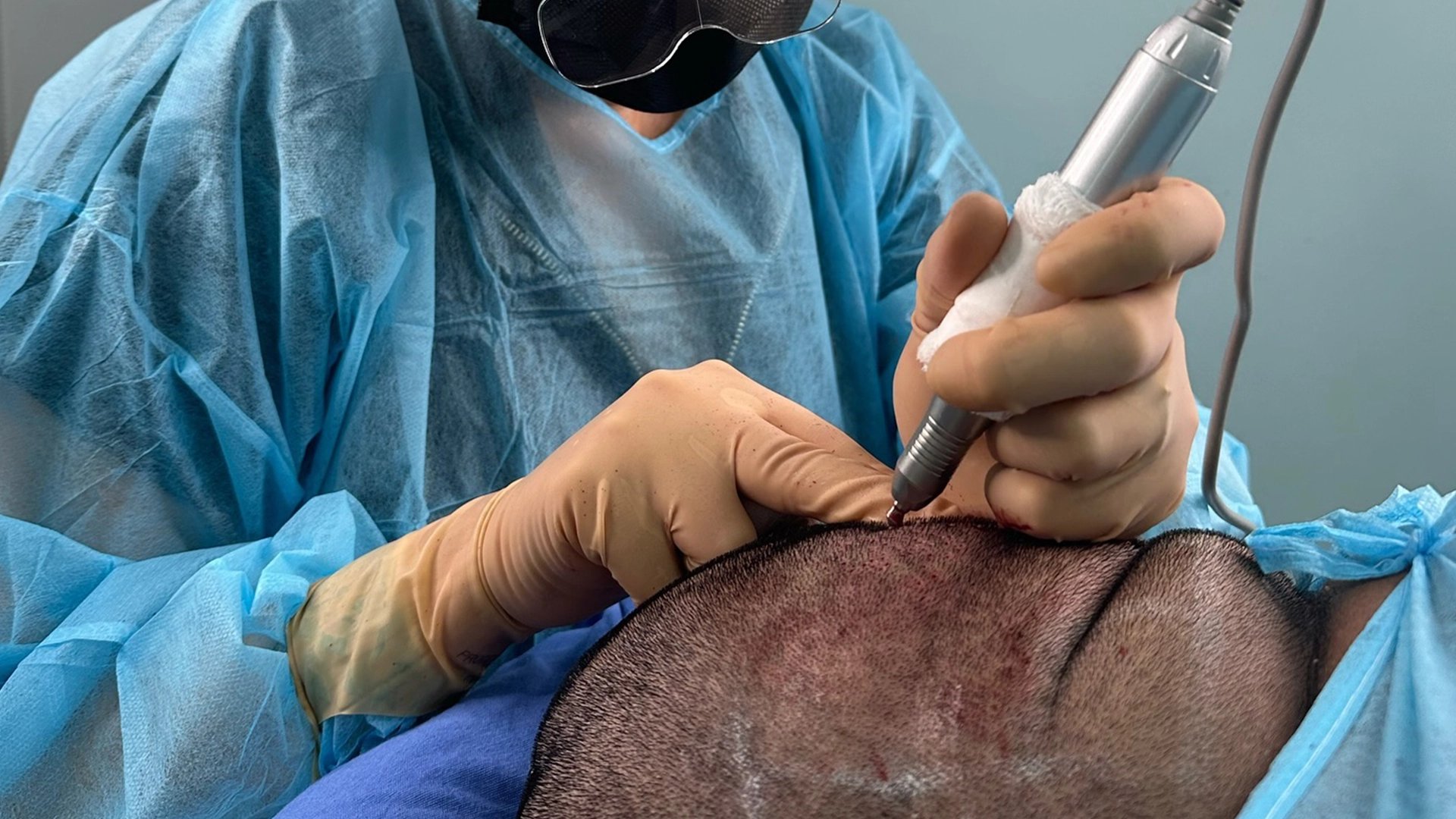 Hair transplant 1080×1920 IM4